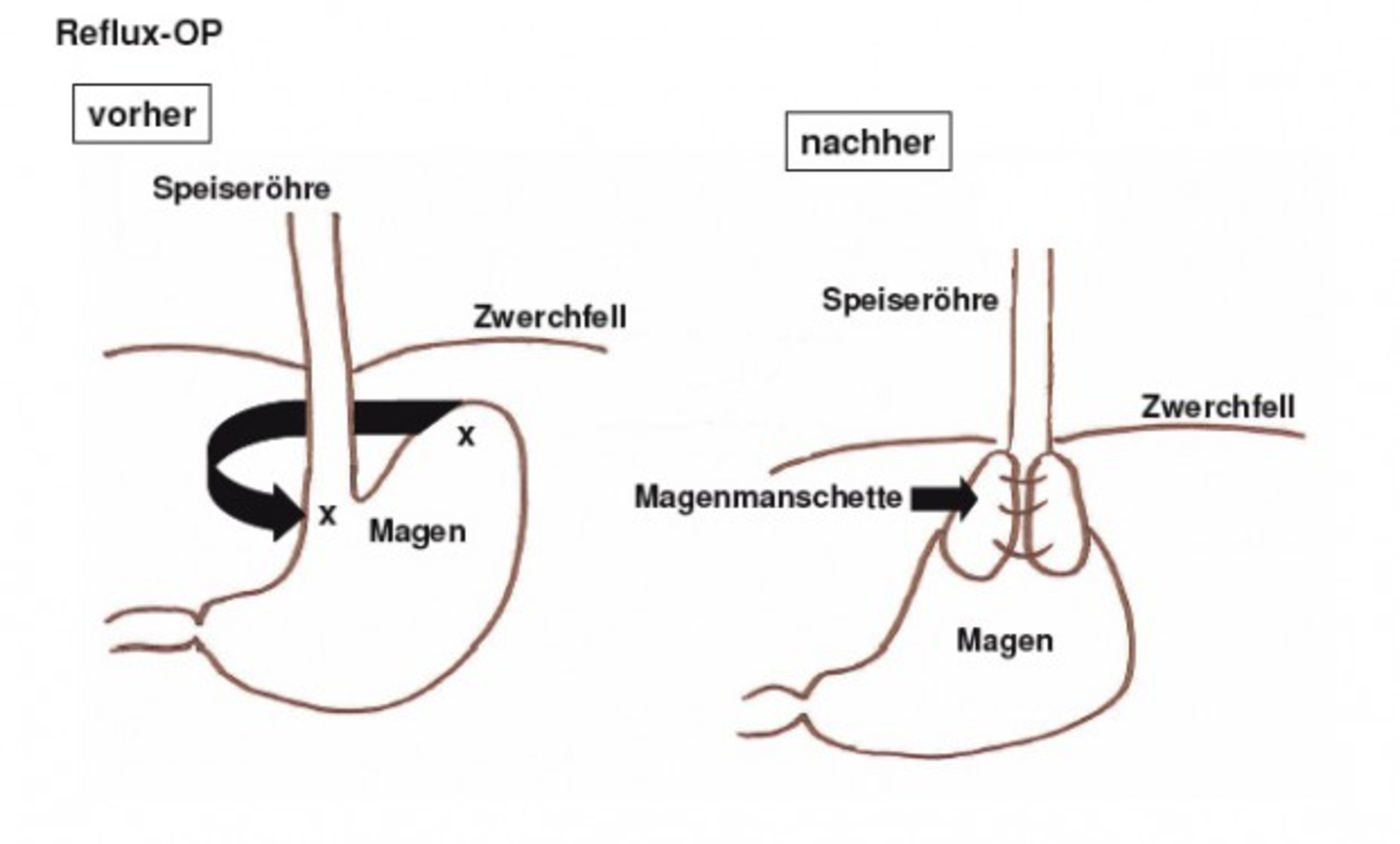 Scharfes Brennen im Kehlenbereich - Imst
