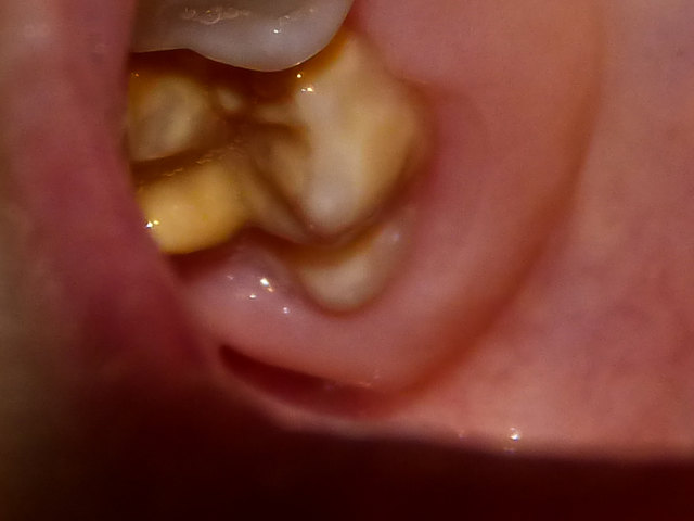 Zahnschmelzschädigung (Video) - Kufstein