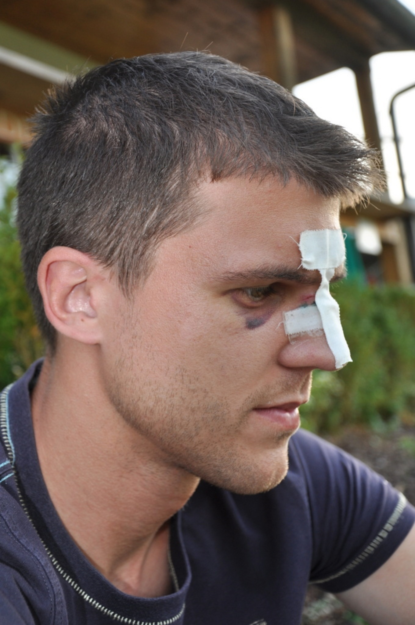 Nasenbruch und blaues Auge - Freistadt