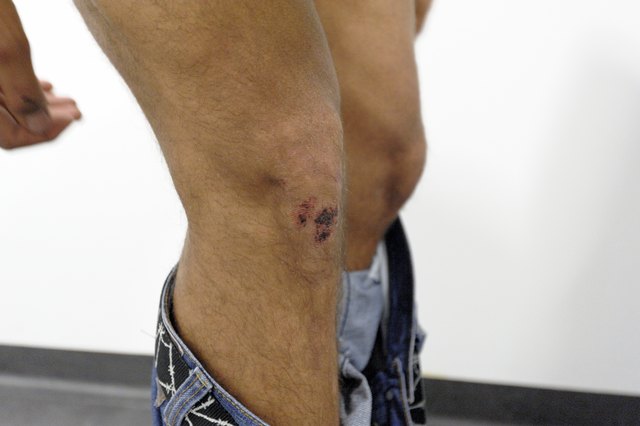Der 18-Jährige humpelt noch. Auch das Knie hat was abbekommen.