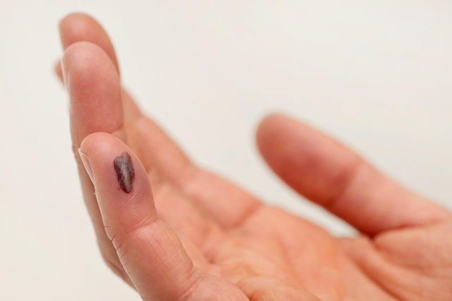 Blutblase Am Finger Was Tun www.meinbezirk.at