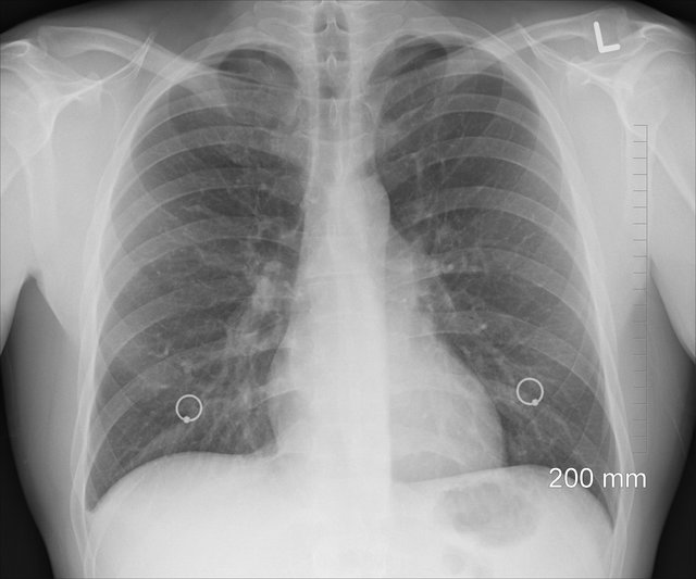 Die Tuberkulose ist eine Infektionskrankheit, die durch Bakterien ausgelöst wird und in erster Linie die Lunge betrifft. | Foto: pixabay