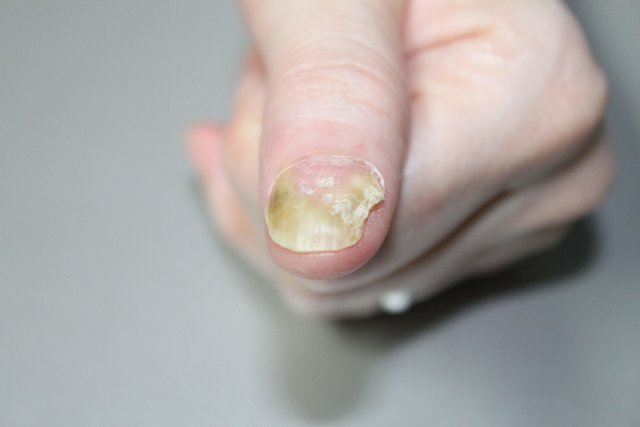 Neue Therapieoption: Laser gegen Nagelpilz - Horn