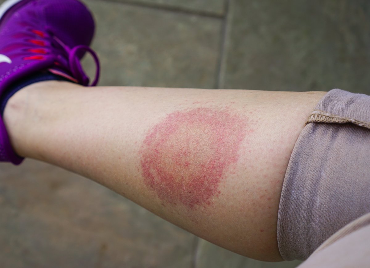 Borreliose Viel Haufiger Als Fsme Innere Stadt
