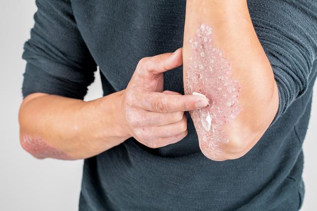 Psoriasis zeigt sich oft am Ellenbogen. | Foto: Fuss Sergey/Shutterstock.com