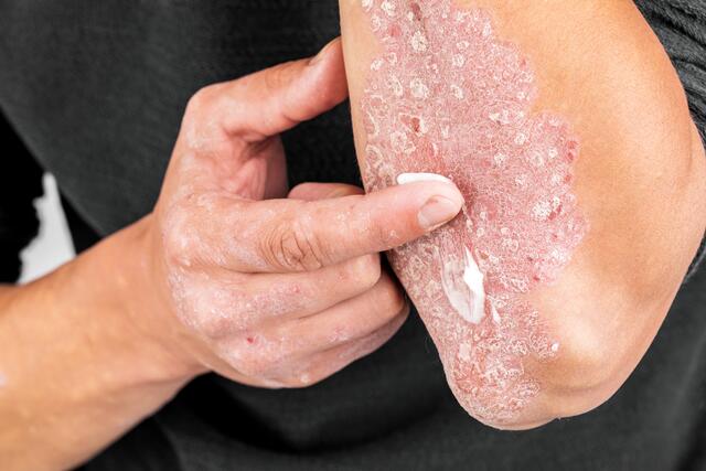 Psoriasis braucht eine besondere Hautpflege.