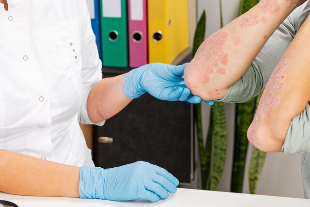 Was bedeutet COVID-19 für Psoriatiker? | Foto: Fuss Sergey/Shutterstock.com