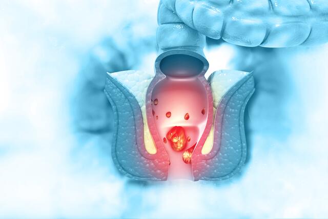 Immer noch sind Hämorrhoiden ein Tabuthema. | Foto: crystal light/Shutterstock.com