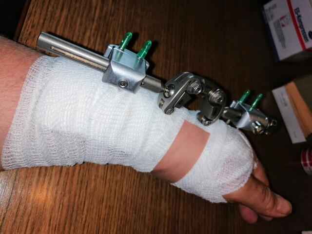 Fixateur an der Hand. Die unbedingt nötige Behandlung nach einem gröberen Fahrradsturz. Die Hand ist nach ca. sechs Wochen mit diesem Fixateur wieder fast vollständig einsatzbereit, obwohl die Speiche und die Handwurzelknochen schweren Schaden genommen hatten. | Foto: Ernst Ranftl