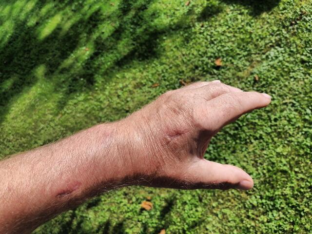 Zwei Wochen, nach Entfernung des Fixateures. Super verheilt und schon sehr gut beweglich.