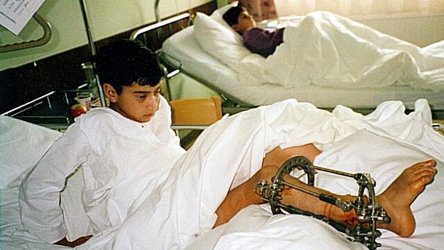 Esmathullah (li) mit einem sogenannten Ilizarov Fixateur und Safjullah (re).