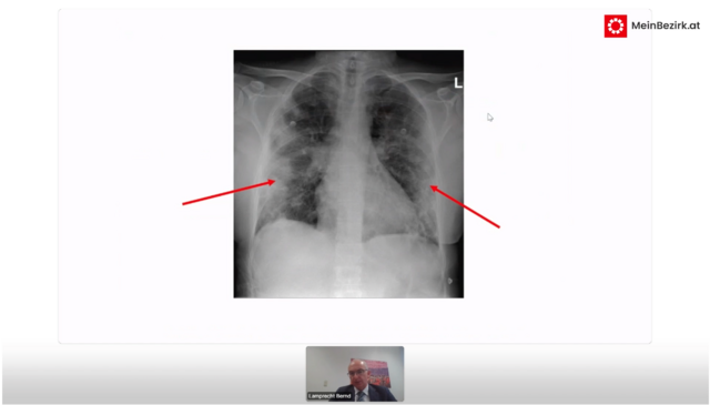 Lungenröntgen eines Corona-Patienten: Die roten Pfeile weisen auf jene weißen Bereiche hin, die entzündete Bereiche der Lunge zeigen. | Foto: Screenshot Vortrag Dr. Bernd Lamprecht