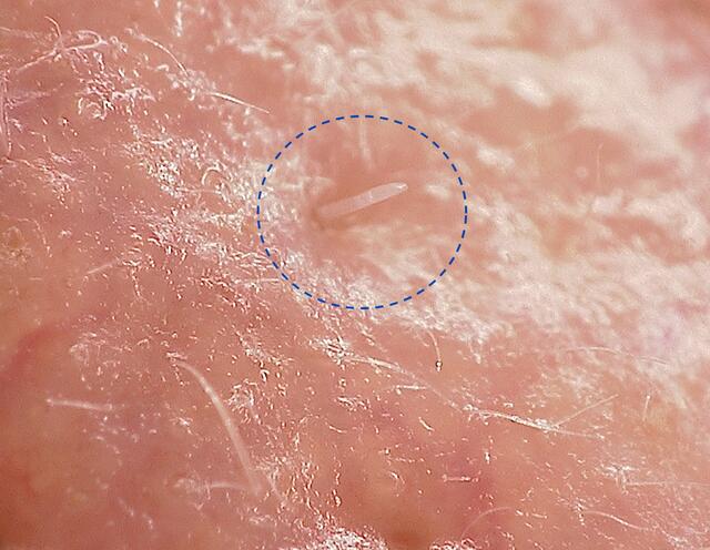 Mikroskopische Aufnahme einer in einer Hautpore steckenden Demodex folliculorum-Milbe. | Foto: Alejandra Perotti