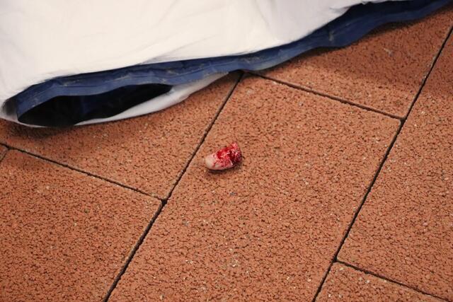 Große Zehe ab - die Wunde wurde erstversorgt, das Zehenstück fachmännisch verpackt und der Rettung übergeben. | Foto: Edith Ertl