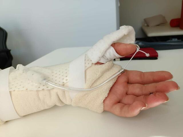 Die Ergotherapie kann bei Beeinträchtigung der Handfunktion in der Rehabilitation helfen. | Foto: Praxis Auenweg