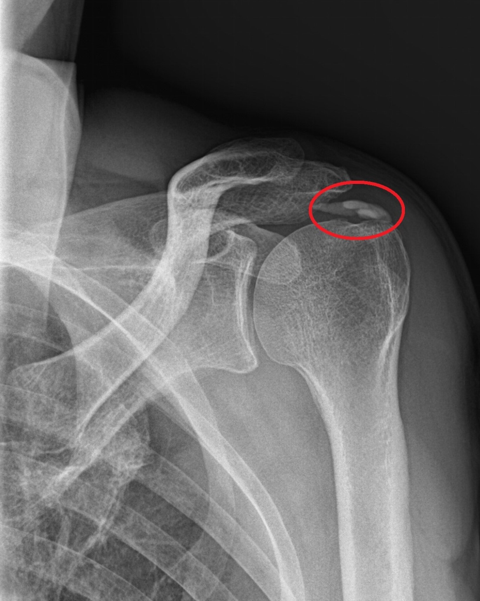 Schmerzen in der Schulter: Häufigste Ursache ist die \