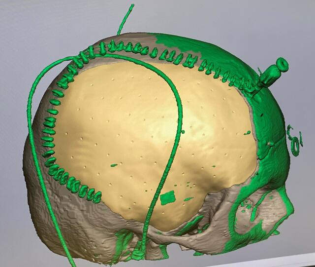 Das Implantat wurde am Computer anhand der CT-Bilder entwickelt. | Foto: SALK/Fürweger