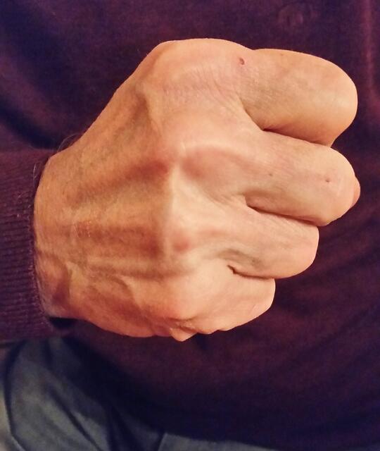 Trümmerbruch und Gehirnerschütterung SYMBOLBILD | Foto: IP