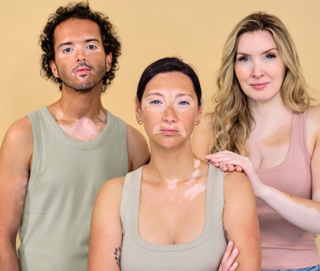 Viele Fehlinformationen tummeln sich um die Hauterkrankung Vitiligo, die auch als Weißfleckenkrankheit bekannt ist. | Foto: Incyte Biosciences Germany GmbH