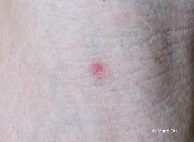 Tigermücken-Invasion Graz