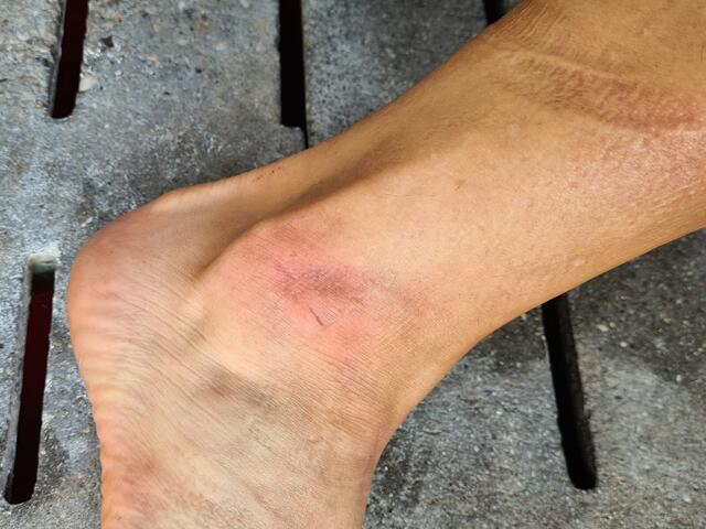 Das Fazit der Aktion: schmerzende Hüften und offene Stellen an den Fußgelenken.  | Foto: VGT.at