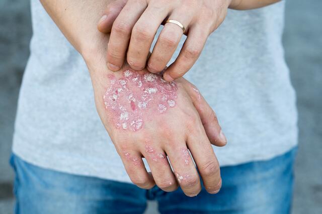 Depressionen sind häufige Begleiter der Psoriasis. | Foto: Panthermedia