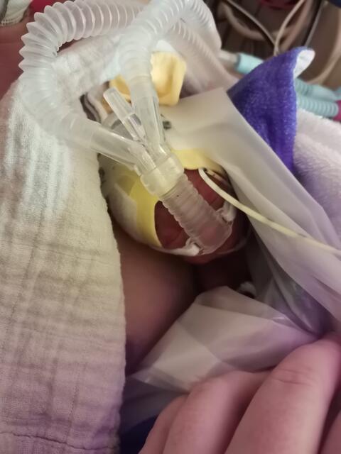 Johanna musste immer wieder beatmet werden. | Foto: Karrer