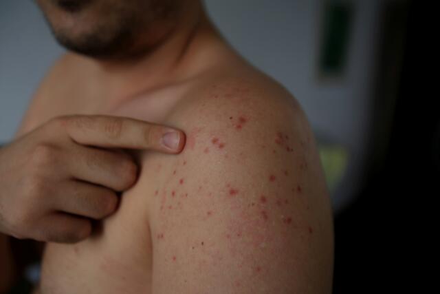 Rund zehn Prozent der Menschen in Österreich sind nicht gegen Masern immunisiert. | Foto: PantherMedia/joasouza
