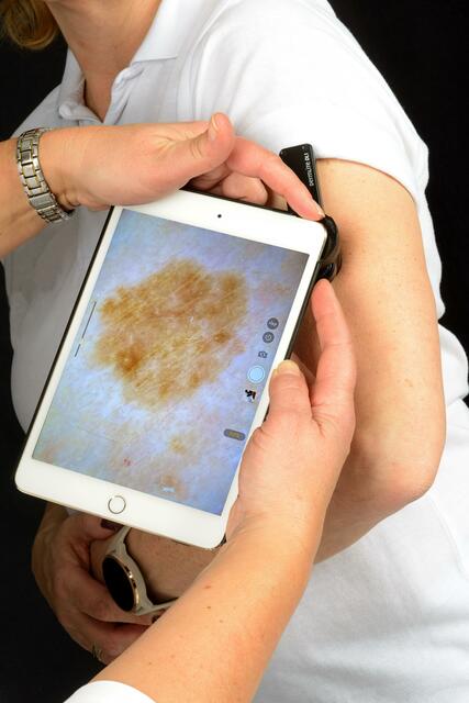 Hautdiagnosen via Tablet sollen in Zukunft in der Steiermark flächendeckend gestellt werden können. Mitwirkende Hausärztinnen und Hausärzte erhalten ein Tablet mit einem auflichtmikroskopischen Aufsatz. | Foto: Werner Stieber