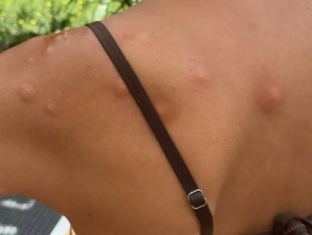 Eine Besucherin bekam einen Ausschlag mit Juckreiz. | Foto: privat