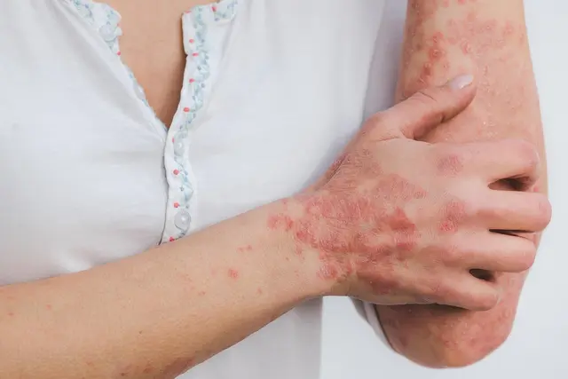 Psoriasis ist für Betroffene sehr belastend. Maßvolle Sonnenbäder empfinden sie oft als wohltuend in Bezug auf die Beschwerden. | Foto: Pixabay.com