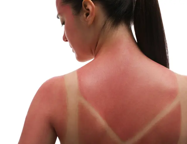 Viele Hausmittel gegen Sonnenbrand können mehr schaden als helfen. | Foto: PantherMedia/NewAfrica