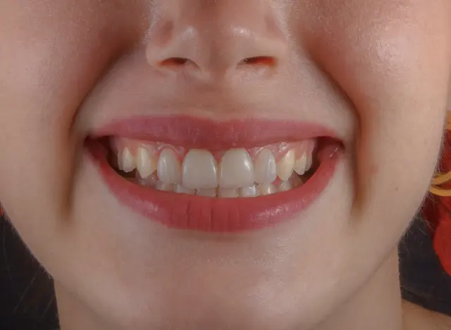 Für gesunde Zähne und ein strahlendes Lächeln ist Speichel essenziell. Dieser steht am Tag der Zahngesundheit im Fokus. | Foto: unsplash.com/Ozkan Guner
