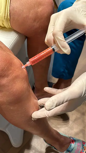 Besonders bei Gelenkbeschwerden wie Arthrose oder Sehnenverletzungen eröffnen Fettstammzellen neue Perspektiven für die Heilung. | Foto: healthdoctors