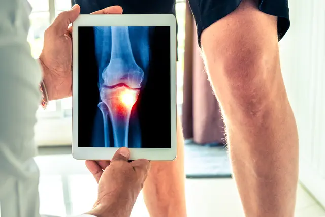 Arthrose ist nach derzeitigem Stand der Wissenschaft nicht heilbar, aber die Beschwerden lassen sich oft lindern und das Fortschreiten der Gelenkabnützung verzögern | Foto: steph photographies/stock.adobe.com