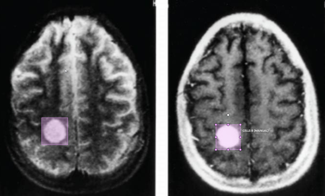 Auch medizinische Anwendungen, etwa bei der Tumorerkennung, setzen auf speziell trainierte KI-Anwendungen | Foto: RAS Gmbh