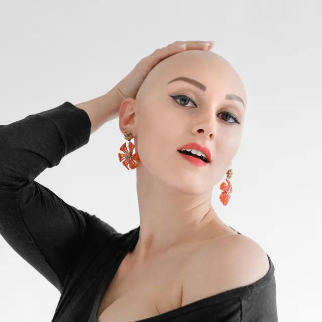 Lisa Maria Masser leidet seit ihrem sechsten Lebensjahr an Haarausfall. | Foto: Elena