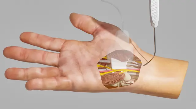 Die Behandlung des Karpaltunnelsyndroms (und auch des „schnellenden Fingers“) wird über kleinste Stichinzisionen unter Ultraschallkontrolle durchgeführt. Die neue Methode kommt in der Regel ohne klassischen Hautschnitt aus. | Foto: Spirecut