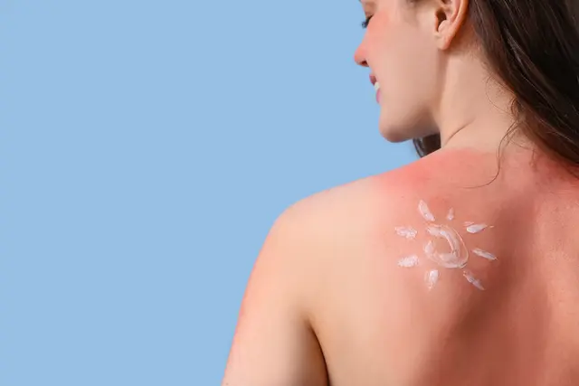 Um einer Sonnenallergie vorzubeugen, sollte man sich der Sonne anfangs nur in Maßen aussetzen. Der Sonnenbrand kann dagegen auch bei einer kurzfristigen Bräunung vorkommen. | Foto: stock.adobe.com/Pixel-Shot
