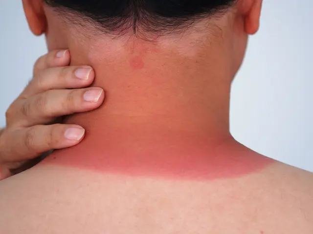 Wenn das Sonnenbad doch zu intensiv war ... | Foto: ERGO Group/Canva