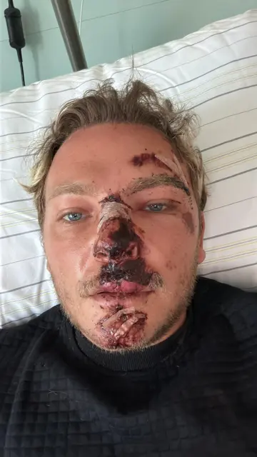 Michael Kleinheinz nach seinem Sturz: "Der Unfall hat mich völlig aus dem Leben gerissen!" | Foto: Kleinheinz