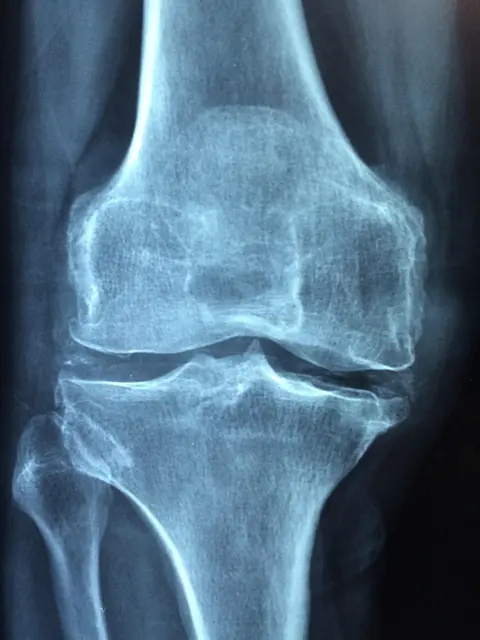 Arthrose / Abnützung des Kniegelenks mit Osteophyten (Anbauten am Gelenksrand), Sklerose (weiße Verdichtung angrenzend an den Gelenksspalt), Gelenkspaltverschmälerung | Foto: https://pixabay.com/photos/knee-old-care-injury-pain-1406964/