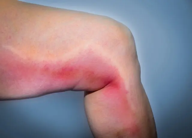 Eine Thrombose äußert sich unter anderem durch Schwellung eines Beins oder einer Wade. | Foto: hriana/Smarterpix